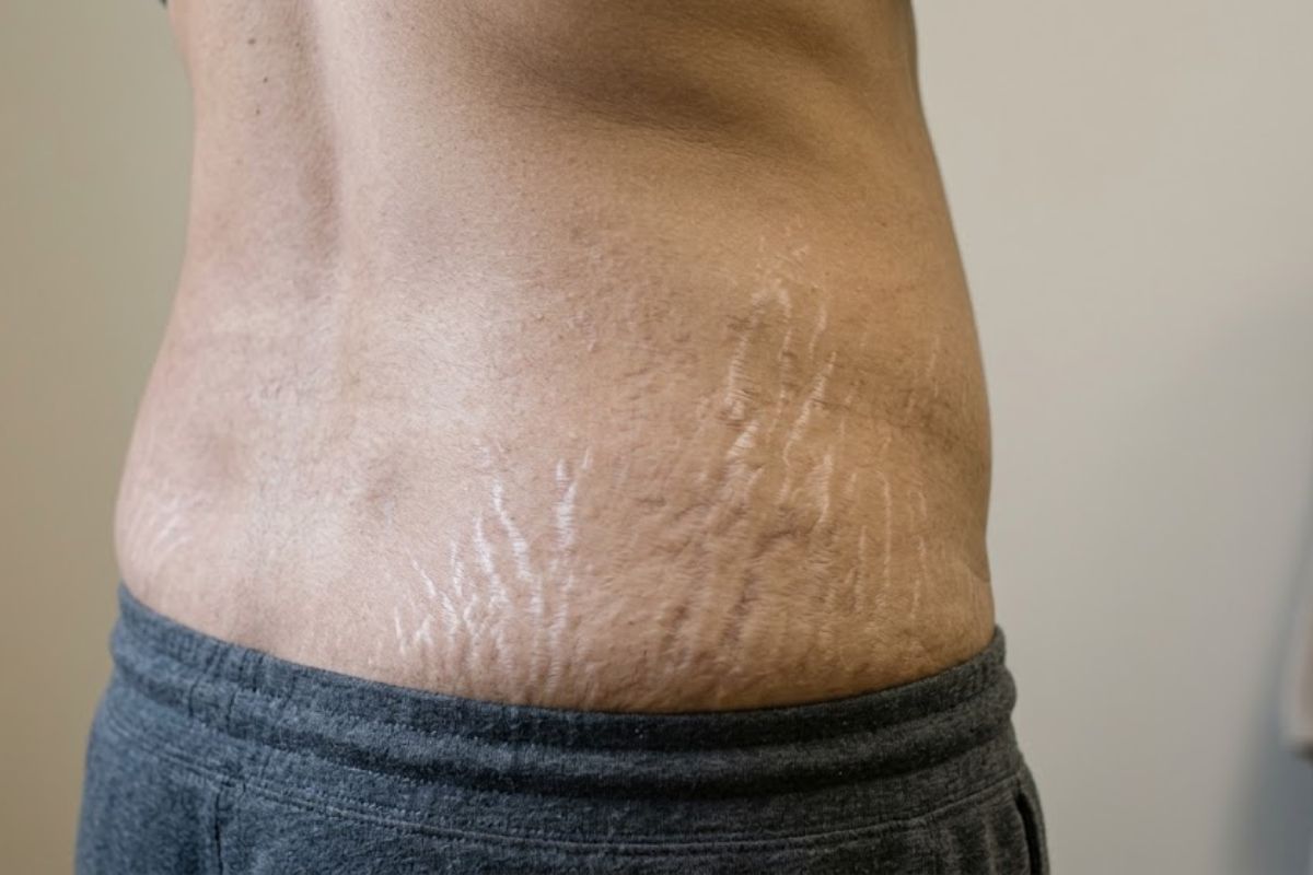 Before treatment
